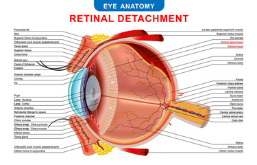 Retinal detachment. Eye condition: detachment of the retina from choroid.