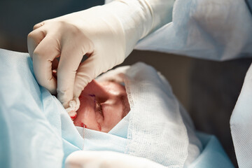 Naklejka premium Close up of the face of a patient who is undergoing blepharoplasty. The surgeon cuts the eyelid and performs manipulations using medical instruments