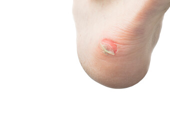 Naklejka premium inflamed dried corn with peeling skin on the heel. white background