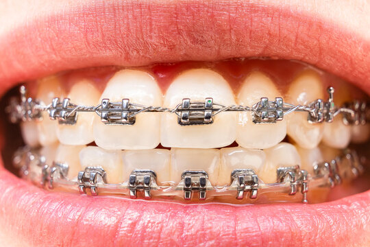Foreground teeth with braces with traces of food. Dental care photo. Smile woman with orthodontic accessories. Orthodontic treatment
