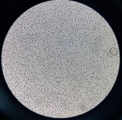 Semen analysis, sperm analysis on microscopic examination, Normozoospermia, normal semen analysis