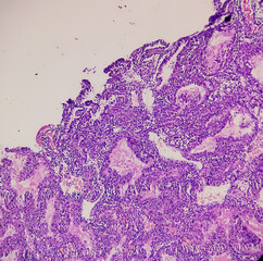 Molar pregnancy(curettage), microscopic image compatible with hydatidiform mole, show hydrophic...