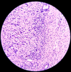 Inflammatory breast lump, Chronic nonspecific mastitis with fibrocystic changes and ductal hyperplasia, no malignant cell.