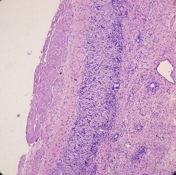 Inflammatory breast lump, Chronic nonspecific mastitis with fibrocystic changes and ductal hyperplasia, no malignant cell.