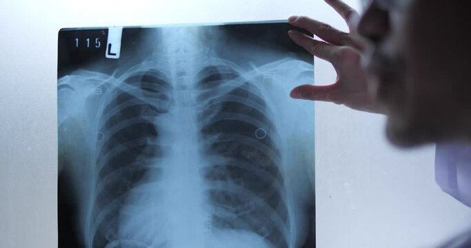 A doctor will examine a Covid-19 patient's x-ray for pneumonia in the hospital. The hypothesis of a Coronavirus