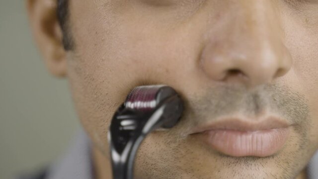 Close up shot of Handsome Man using derma roller on face - concept treatment or therapy of skin, acne scarring and Facial massage