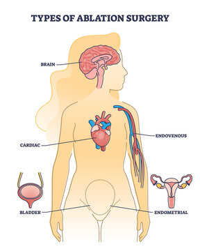 Types of ablation surgery with brain and cardiac example outline diagram. Labeled educational medical procedure and catheter ablation with endometrial, bladder or endovenous method vector illustration