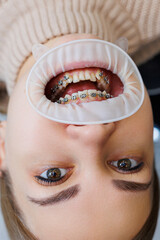 Close-up of mouth and teeth with metal braces. Orthodontic dental treatment