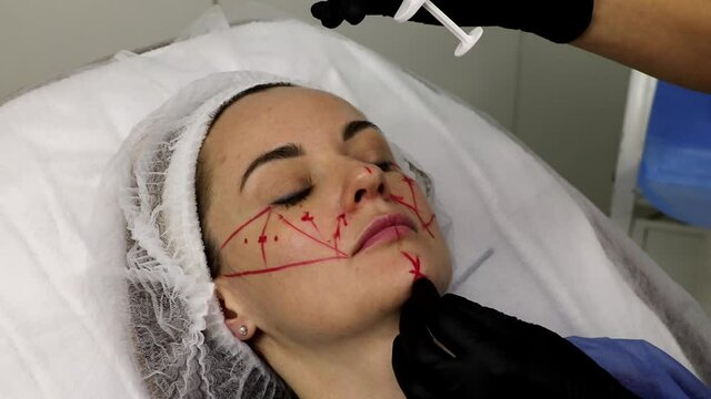 Correction of the chin with a filler according to the markings marked with a marker.