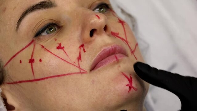Correction of the chin with a filler according to the markings marked with a marker.