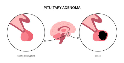 Pituitary adenoma cancer
