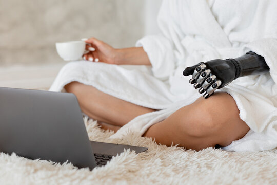 Girl with a prosthesis on her arm uses a laptop