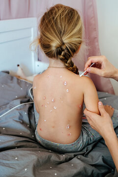 Crop Woman Applying Medical Ointment, Chickenpox