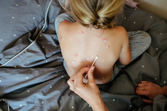 Mother treating kid with chickenpox