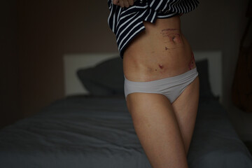 demonstration of the consequences after ovarian cyst