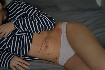 consequences after peritonitis