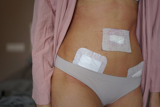  girl after laparoscopy and  peritonitis