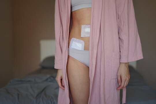  girl after laparoscopy and  peritonitis