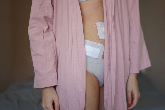 a woman shows off her stomach after surgery