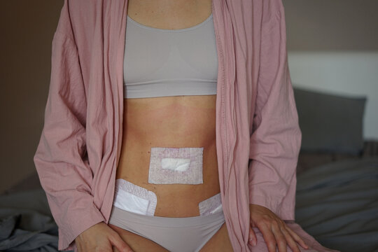  girl after laparoscopy and  peritonitis