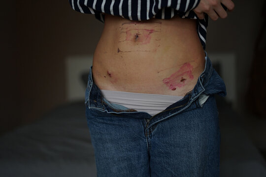 consequences after peritonitis