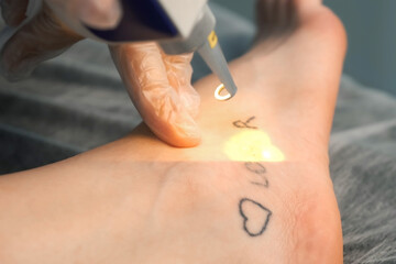 Laser removing of tattoo with words loser, lover and heart on woman's foot in red and black...