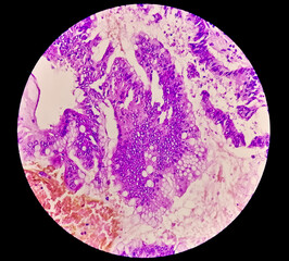 Photomicrograph showing adenocarcinoma. cancer, oncology, histology. 40x