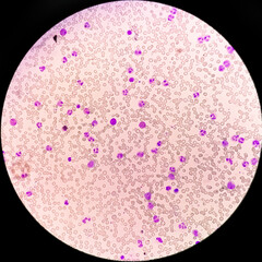 Chronic myelocytic leukemia (CML)  with chronic phase. Hematology. 