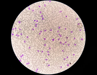 Chronic myelocytic leukemia (CML)  with chronic phase. Hematology. 