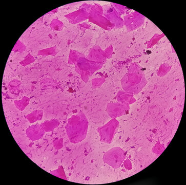 High Vaginal Swab (HVS) gram stain microscopic 40x show few pus cells and epithelial cells. Gram positive Diplococci and Gram negative rods shape bacteria.