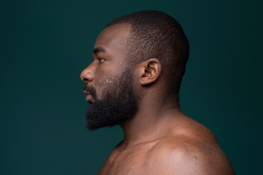African man with skin problems side profile