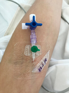 Cannula in Patient's Arm