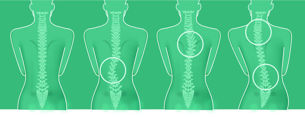 Schiena donna colonna vertebrale problemi scoliosi