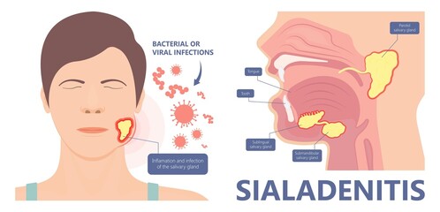 Parotid gland Sialadenitis bacterial infection Sialolithiasis blockage swelling treat Infiltrative cancer ear nose doctor calculi stones diagnose surgical examination inflammation saliva - obrazy, fototapety, plakaty