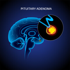 Pituitary adenoma cancer - obrazy, fototapety, plakaty