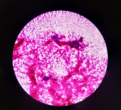 Pleomorphic adenoma. Left parotid swelling (FNA) hematoxylin and eosin stained microscopic 100x show Pleomorphic adenoma. background hemorrhage seen.