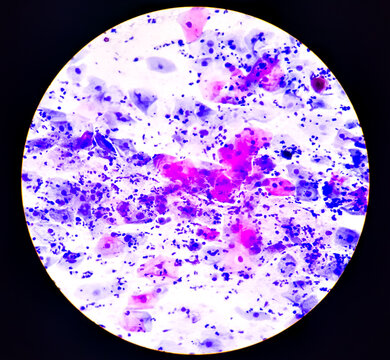 Cervical cancer cells. Atypical glandular cells, Adenocarcinoma of cervix, Pap's smear cervical cancer diagnosis. microscopic 100x image