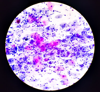 Cervical cancer cells. Atypical glandular cells, Adenocarcinoma of cervix, Pap's smear cervical cancer diagnosis. microscopic 100x image