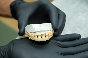 mold of teeth at the dentist in his hands