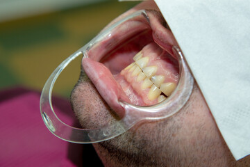 open mouth for dental treatment
