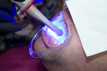 open mouth for dental treatment with ultraviolet treatment