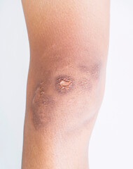 Scar and blemishes Dark spots on the skin of the person on the leg