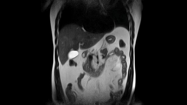 CT scan of the abdomen. Computed tomography of the gastrointestinal tract, liver and kidneys.