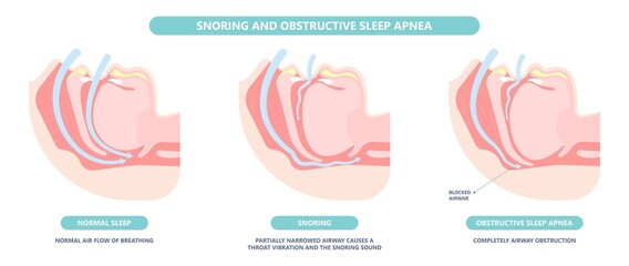 Somnoplasty. Throat back voice box larynx vocal cord pain airway endoscopic sinus surgery ear nose sleep apnea oral airway septal obstructive biopsy tumor Pharynx flexible fibre optic polypectomy