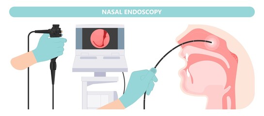 Nasal Endoscopy. Throat back voice box larynx vocal cord pain airway endoscopic sinus surgery ear nose sleep apnea oral airway septal obstructive biopsy tumor Pharynx flexible fibre optic polypectomy