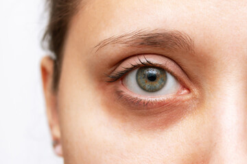 Cropped shot of a young woman's face with dark circle under eye isolated on a white background....