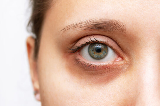 Cropped shot of a young woman's face with dark circle under eye isolated on a white background. Bruise under the eyes are caused by fatigue, nervousness, lack of sleep, insomnia and stress