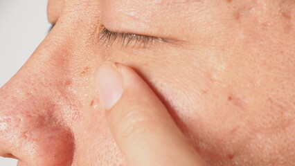 Wart on face. Macro shot of wart near eye. Papilloma on skin around eye nose and neck. Close up of birthmark Papilla or mole on skin. small hard. benign growth on the skin. caused by virus. skincare.