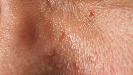 Fototapeta premium Wart on face. Macro shot of wart near eye. Papilloma on skin around eye nose and neck. Close up of birthmark Papilla or mole on skin. small hard. benign growth on the skin. caused by virus. skincare.