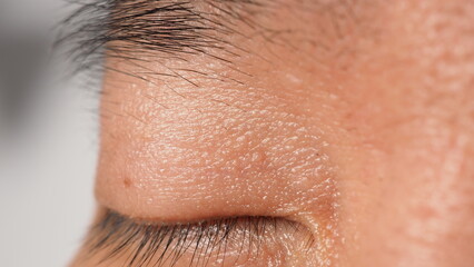Wart on face. Macro shot of wart near eye. Papilloma on skin around eye nose and neck. Close up of birthmark Papilla or mole on skin. small hard. benign growth on the skin. caused by virus. skincare.